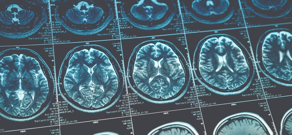 Traumatic Brain Injuries