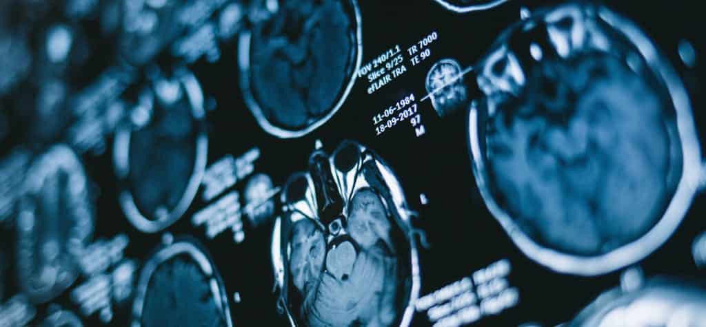 Close-up view of MRI brain scans, showcasing detailed images of the brain's internal structures.