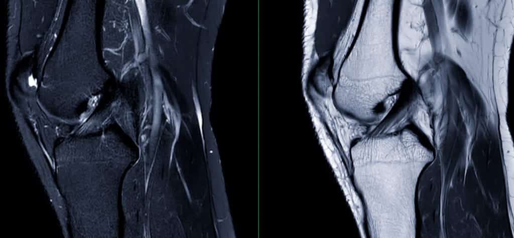 MRI scans showing detailed images of knee joints, highlighting the clarity of soft tissue structures.